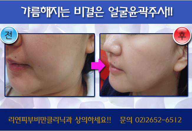 리연클리닉 윤곽주사 전후사진