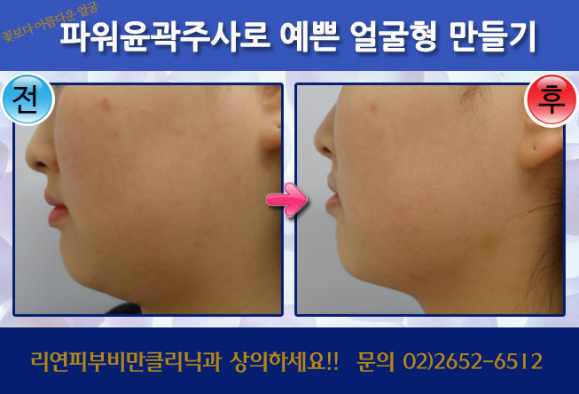 리연클리닉 파워윤곽주사 전후사진