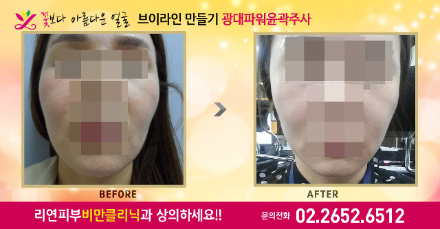 리연클리닉 광대 파워윤곽주사 전후사진