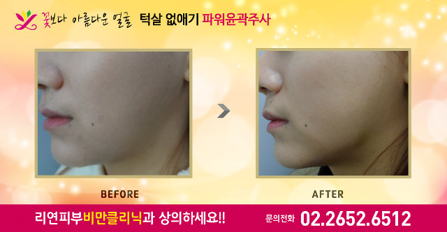 리연클리닉 파워윤곽주사 전후사진