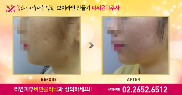 리연클리닉 파워윤곽주사 전후사진