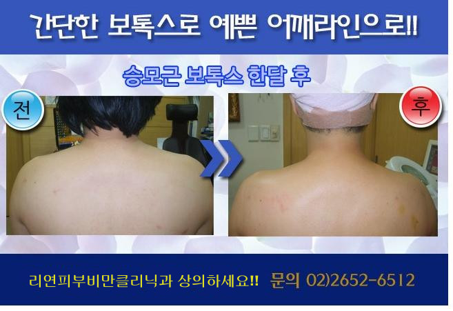 리연클리닉_승모근보톡스_시술전후사진