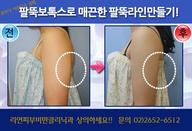 리연클리닉 바디보톡스 전후사진