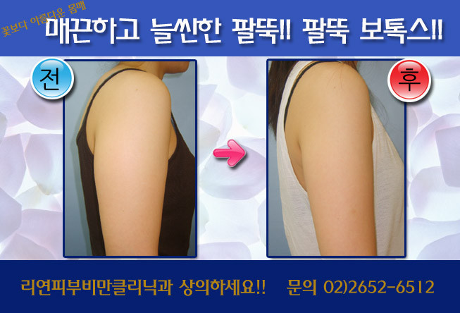 리연클리닉_팔뚝보톡스_시술전후사진