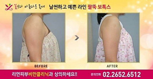 리연클리닉 전후사진