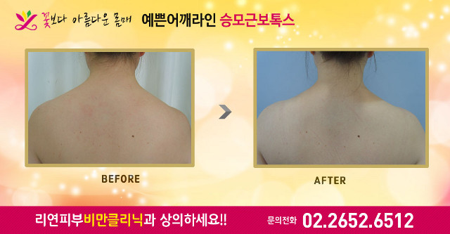 리연클리닉 승모근보톡스 전후사진