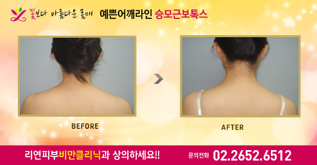 리연클리닉_승모근보톡스_전후사진