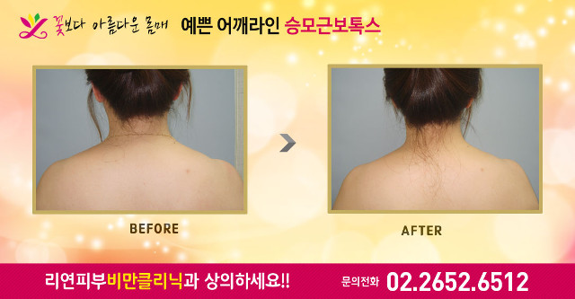 리연클리닉 승모근보톡스