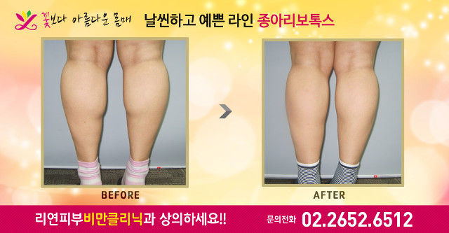 리연클리닉 종아리보톡스