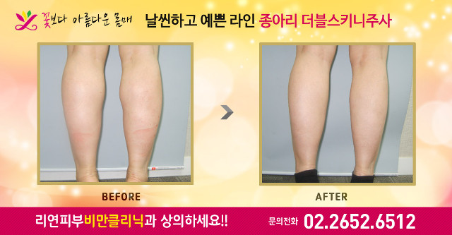 리연의원 종아리보톡스 더블스키니 전후사진