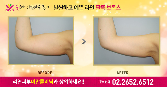 리연클리닉 승모근보톡스 전후사진