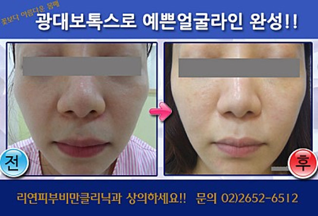 리연클리닉_광대주사_시술전후사진