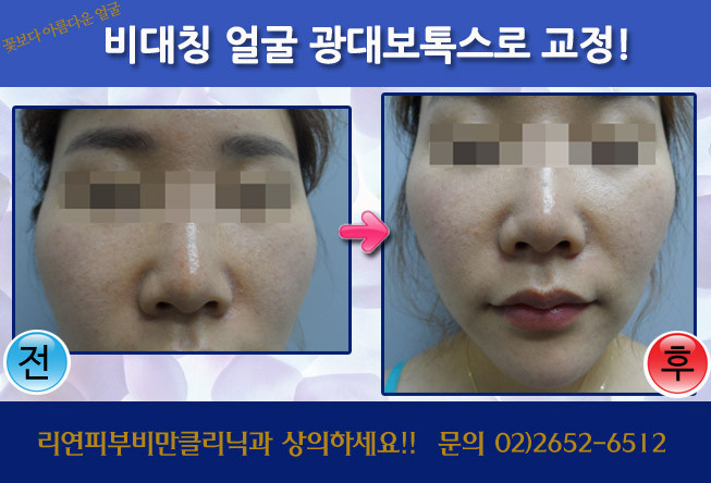 리연클리닉 광대보톡스