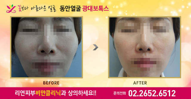 리연의원 광대보톡스 전후사진