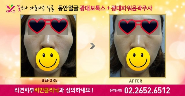 리연의원 광대보톡스 광대파워윤곽주사 전후사진