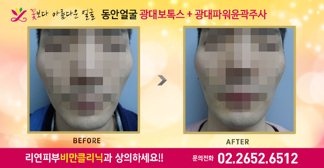 리연의원 광대보톡스 광대파워윤곽주사 전후사진