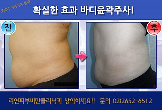 리연클리닉_바디윤곽주사_시술전후사진