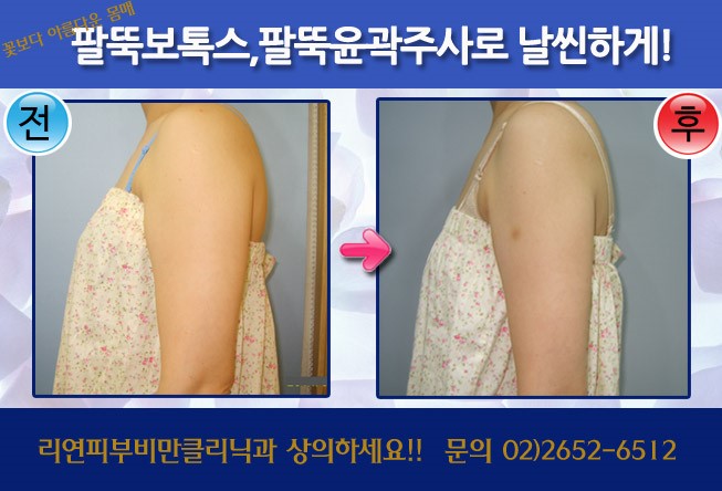 리연클리닉 팔둑주사 팔뚝보톡스 바디윤곽주사