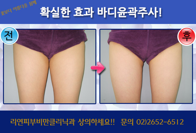 리연클리닉 바디윤곽주사 전후사진