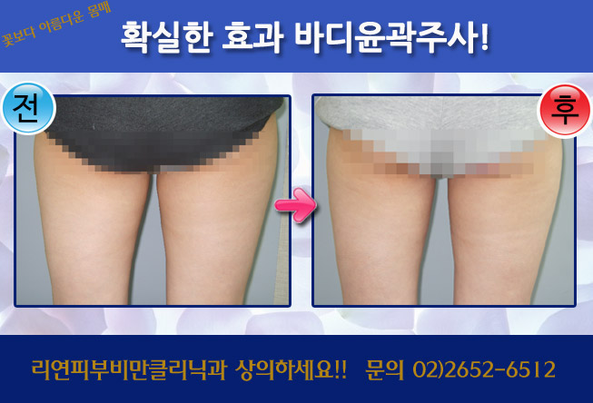 리연클리닉 바디윤곽주사