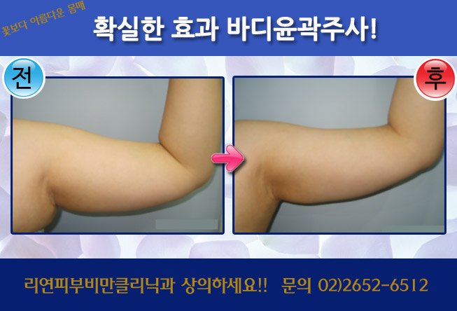 리연클리닉 바디윤곽주사 전후사진