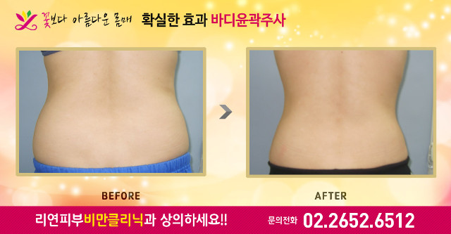 리연의원 러브핸들 지방분해주사 전후사진
