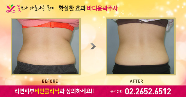 리연의원 러브핸들 지방분해주사 전후사진