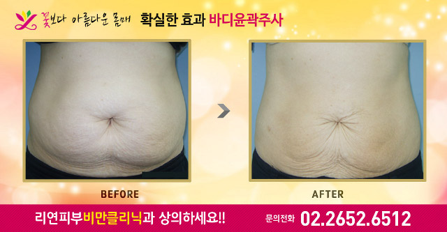 리연클리닉 바디윤곽주사 전후사진