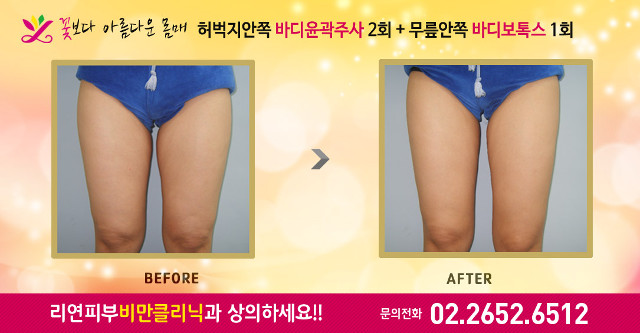 리연클리닉 허벅지안쪽 바디윤곽주사 전후사진