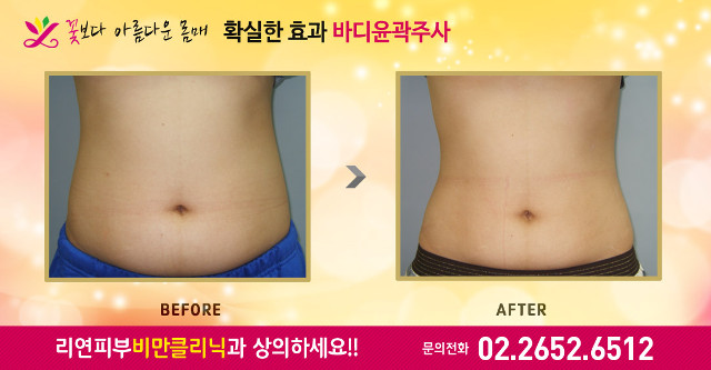 리연클리닉 바디윤곽주사 전후사진