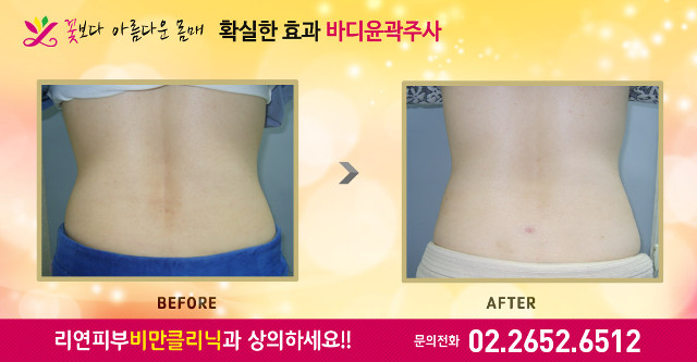 리연클리닉 바디윤곽주사 전후사진