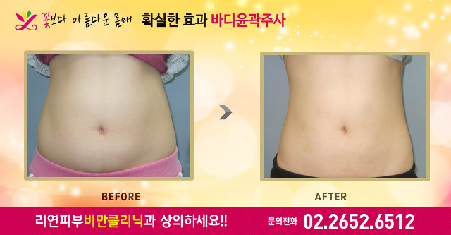 리연클리닉 복부바디윤곽주사 전후사진