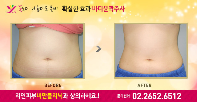 리연의원 러브핸들 지방분해주사 전후사진