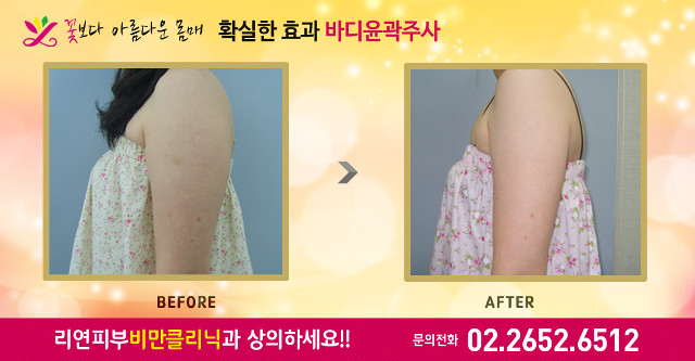 리연클리닉 바디윤곽주사 전후사진