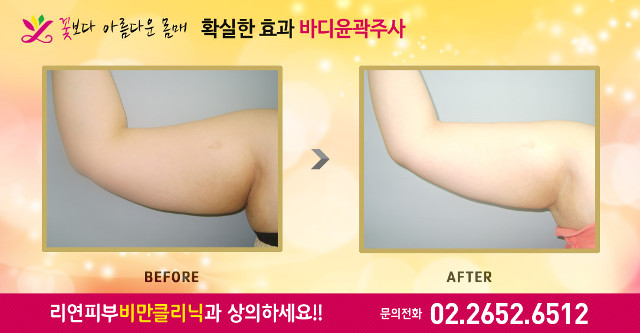 리연클리닉 팔뚝바디윤곽주사 전후사진