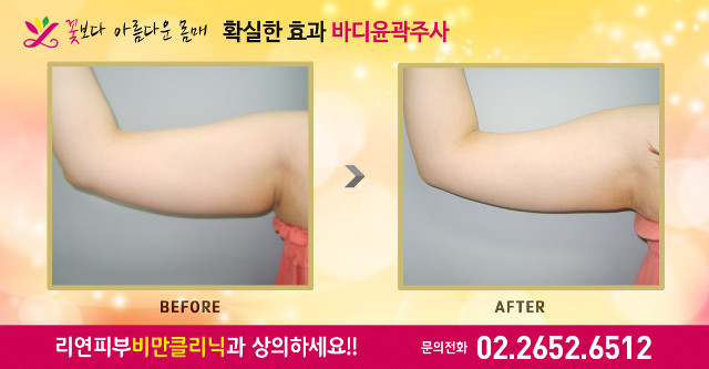 리연의원 팔뚝지방분해주사 전후사진