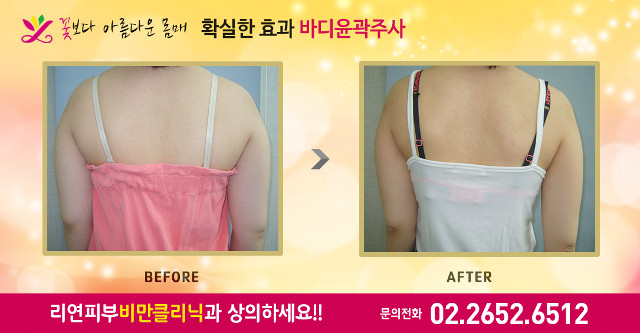 리연의원 팔뚝 지방분해주사 전후사진