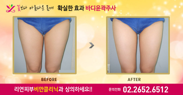 리연클리닉 허벅지바디윤곽주사 전후사진