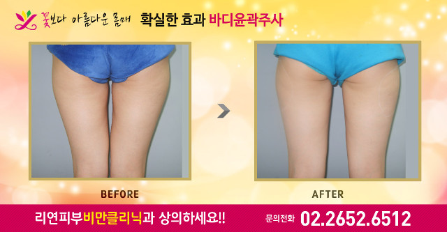 리연클리닉 바디윤곽주사 전후사진
