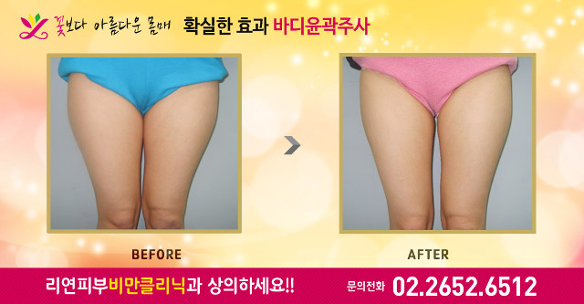 리연클리닉 허벅지바디윤곽주사 전후사진