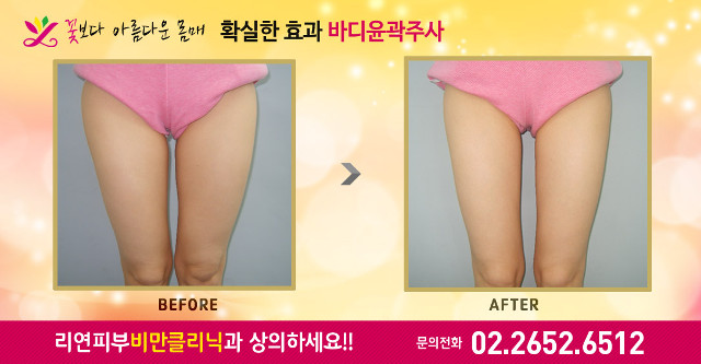 리연클리닉 허벅지바디윤곽주사 전후사진
