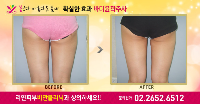 리연클리닉 허벅지바디윤곽주사 전후사진