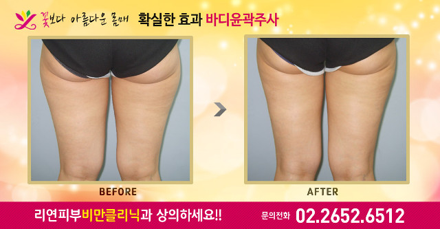 리연의원 허벅지지방분해주사 전후사진