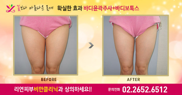 리연의원 허벅지지방분해주사 전후사진