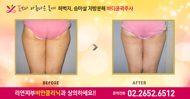 리연의원 승마살 허벅지지방분해주사 전후사진