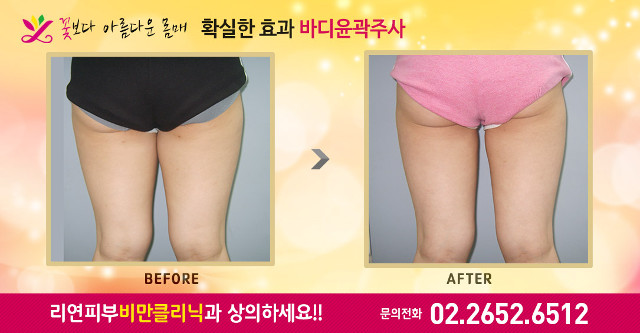 리연의원 허벅지지방분해주사 전후사진