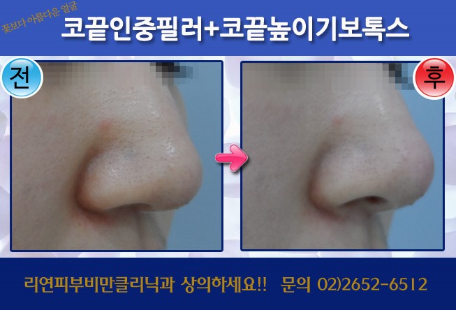 코끝높이기주사