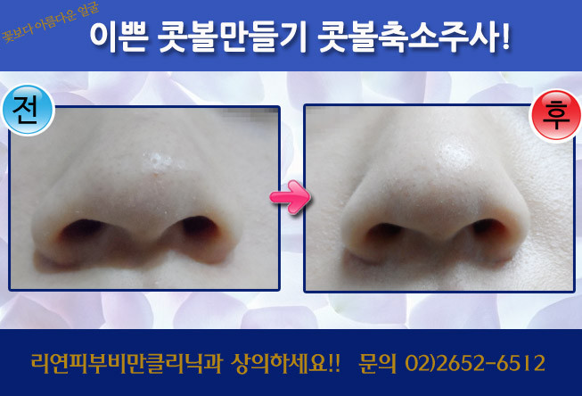 리연클리닉 콧볼주사 전후사진