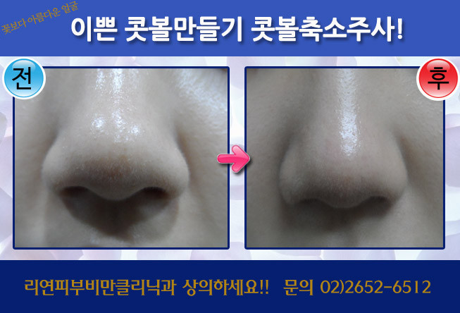 리연클리닉 콧볼축소주사 코조각주사 전후사진