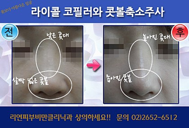 리연클리닉 라이콜필러 콧볼축소주사 전후사진